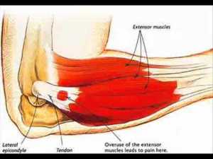 TennisElbow