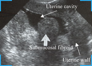 Ultrasound
