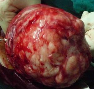 FibroidLarge