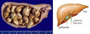 Gallbladder