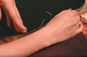 NH_Acupuncture